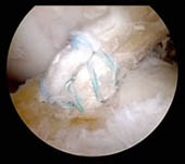 Arthroscopic View of ACL Repair