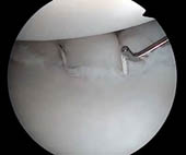 Arthroscopic View of Labral Repair