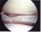 Arthroscopic View of Meniscus Tear